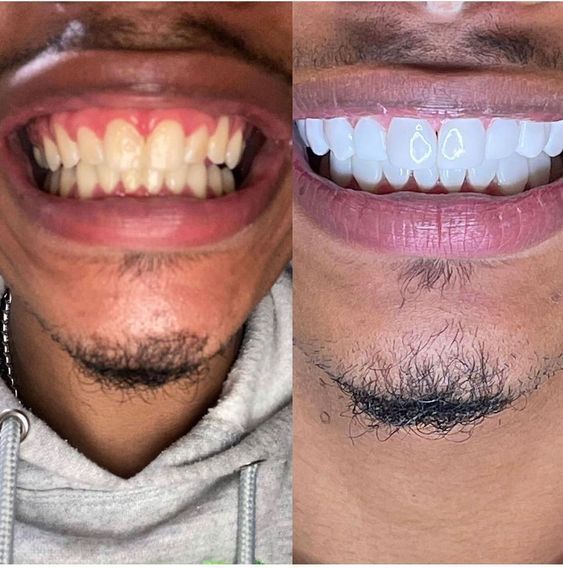Purple Whitening Strips,