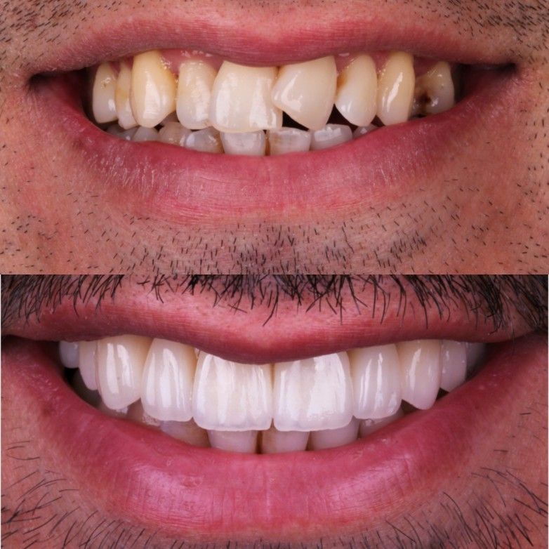 Purple Whitening Strips,