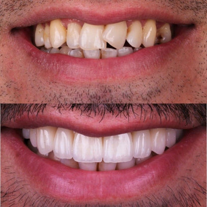 Purple Whitening Strips,