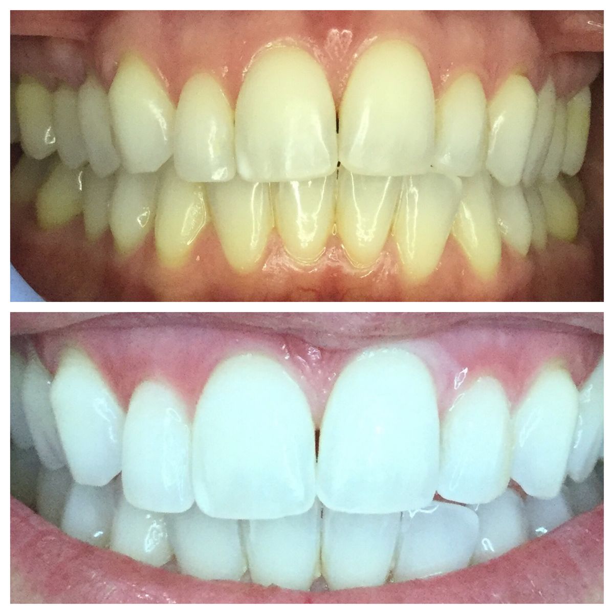 Purple Whitening Strips,